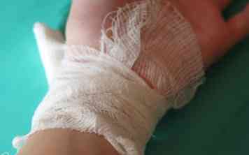 Hvordan man håndterer en ødelagt ben nødsituation 5 trin (med billeder)