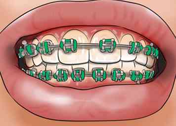 Cómo saber qué hará el ortodoncista cuando reciba frenillos