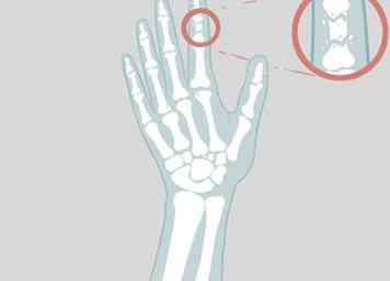 Cómo determinar si un dedo está roto (con imágenes)
