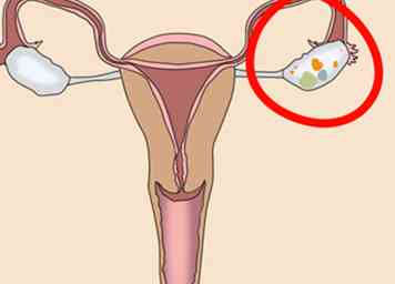3 måder at vide, om du har en æggestokkecyst