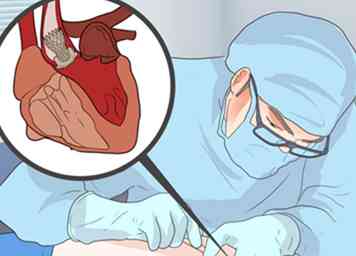 Comment reconnaître une valve cardiaque qui fuit 11 étapes (avec photos)